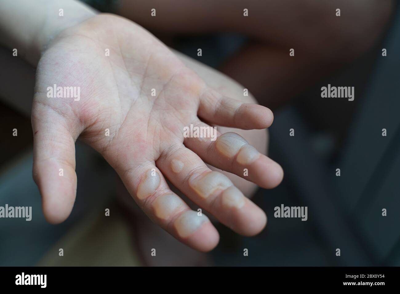 Dogbo : Une femme interpellée pour avoir brûlé la main à son enfant