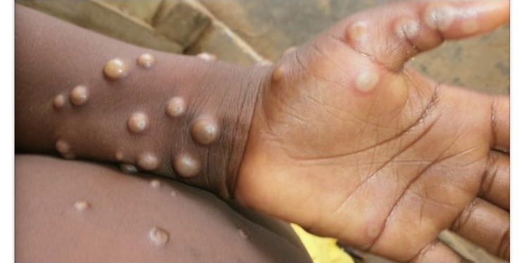 Mpox en Sierra-Leone : Deux cas déjà enregistrés